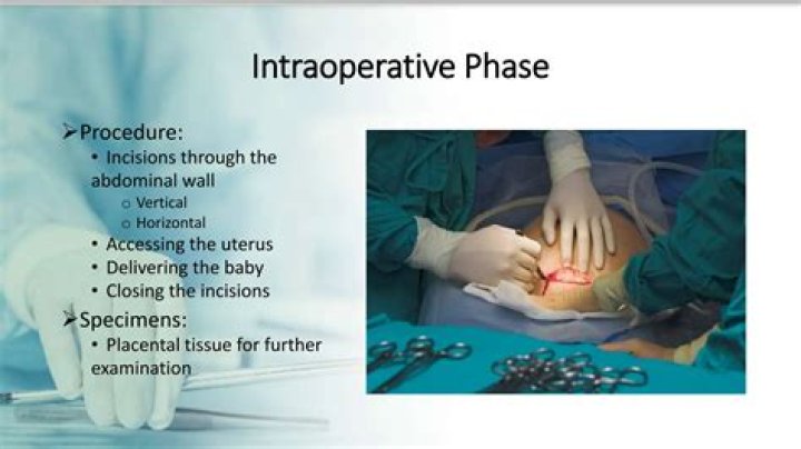 Discoveries For Optimal Post-Cesarean Recovery