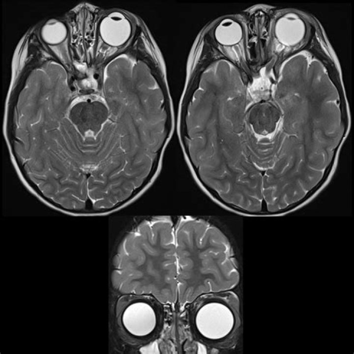 Unveiling The Enigmatic World Of Macrophthalmia: Discoveries And Insights